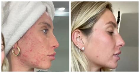 alix earle before accutane|Alix Earle Hints to Having an ‘Accutane Nose Job’